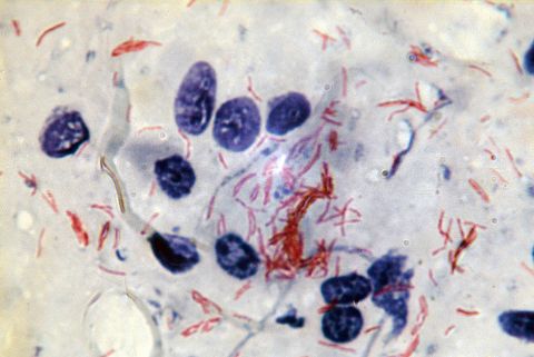 Bacille tuberculeux (Mycobacterium tuberculosis)