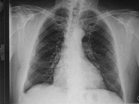 Radiographie des poumons montrant une pathologie liée à l’amiante